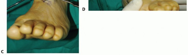 Illustration 33 for Restore Movement: Tendon Transfer for Common Peroneal Nerve Foot Drop