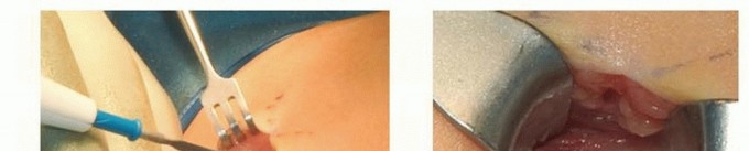 Illustration 12 for Less Pain, More Function: Fassier-Duval Nailing for Osteogenesis Imperfecta