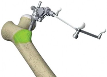 Illustration 29 for Minimizing Risks: Computer Navigation in Hip Resurfacing Arthroplasty