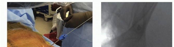 Illustration 33 for Emergency Fixation of the Pelvis: Control Bleeding & Restore Stability