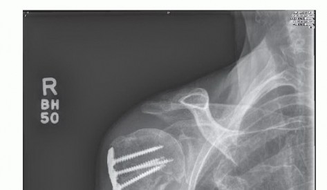 Illustration 3 for Stiff Shoulder? Discover Arthroscopic Capsular Release Solutions