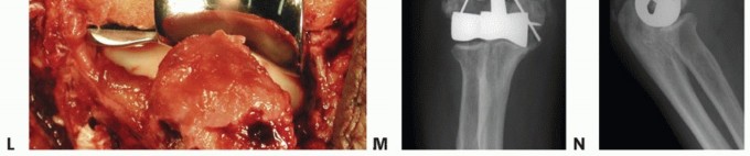 Illustration 31 for Distal Humeral Fractures: When Is Elbow Replacement the Best Option?