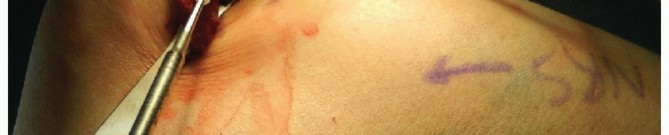 Illustration 42 for Radial Head & Neck Fractures: Mastering ORIF for Best Results