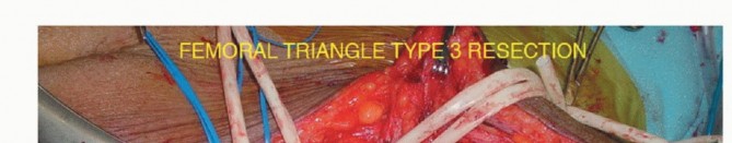 Illustration 7 for Optimizing Resection: An Overview of Surgical Approaches for Space Sarcomas