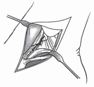 Illustration 21 for Medial Ankle Instability: Find Relief with Reconstruction