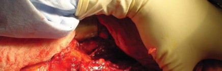 Illustration 12 for Effective Arthroplasty for Salvage of Failed Hip Fixation