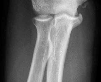 Illustration 2 for Medial Elbow Pain: Diagnosing & Treating Throwing Overload