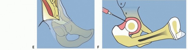 Illustration 20 for Treatment for Congenital Femoral Deficiency: What You Need to Know