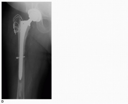 Illustration 29 for Allograft Prosthetic Composite: Mastering Proximal Femur Reconstruction