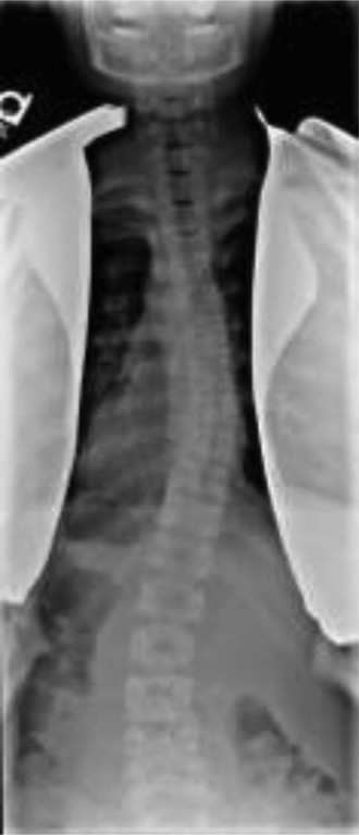 Illustration 4 for Pediatric Scoliosis: When Curves Are Larger Than Degrees, What's Next?