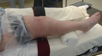 Illustration 17 for Mastering TKA: Essential Methods of Rotational Alignment