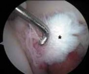 Illustration 38 for Solving Hip Soft Tissue Pathology with Advanced Arthroscopy