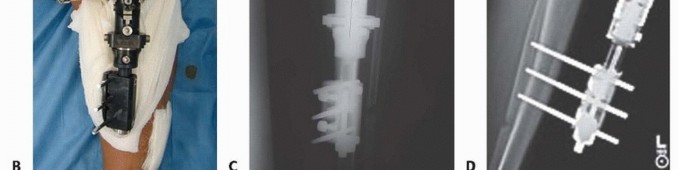 Illustration 9 for Solving Infantile Blount Disease: Surgical Management Strategies