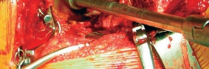 Illustration 36 for Cemented Component Longevity: The Critical Margin of the Acetabulum