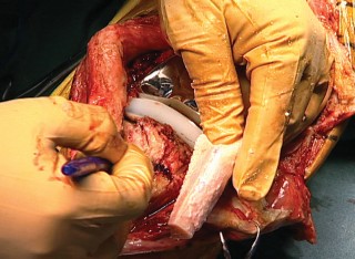 Illustration 14 for Extensor Reconstruction in Total Knee Arthroplasty: Essential Strategies