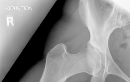 Illustration 3 for Bernese Periacetabular Osteotomy: Your Definitive Case Title Bernese