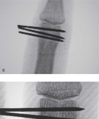 Illustration 2 for Proximal Phalanx Fracture: What's the Best Treatment?