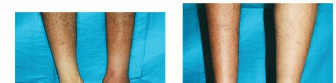 Illustration 84 for Mastering Midfoot Arthrodesis: Protect the Deep Neurovascular Bundle