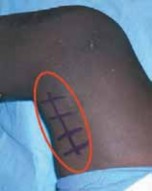 Illustration 16 for Unlocking Mobility: Distal Lengthening for Lateral Hamstring Muscle