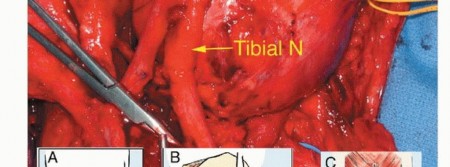 Illustration 19 for Optimizing Resection: An Overview of Surgical Approaches for Space Sarcomas