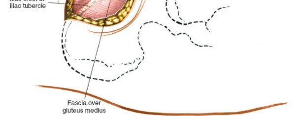 Illustration 7 for Pelvis & Acetabulum Approaches: Unlocking the Posterior Superior Iliac
