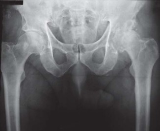 Illustration 42 for Robotics in Total Hip Arthroplasty: A New Era of Precision