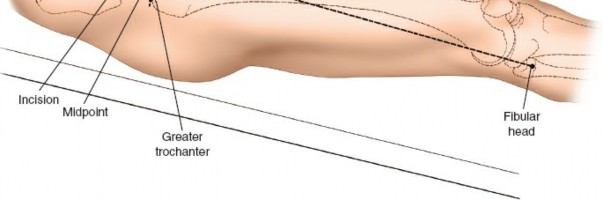 Illustration 82 for Unlocking Every Aspect of the Hip's Surgical Approaches