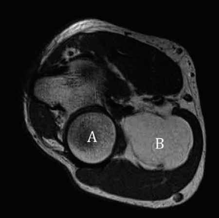 Illustration of examination question lipoma - Dr. Mohammed Hutaif