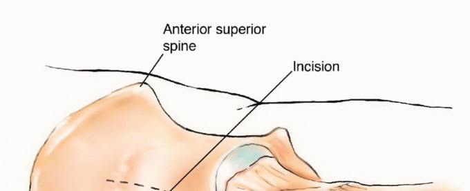 Illustration 4 for Mastering Femoral Metastases: Optimal Function for Femoris & Vastus