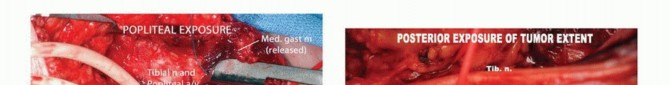 Illustration 11 for Complex Popliteal Resections: Protecting the Greater Saphenous Vein