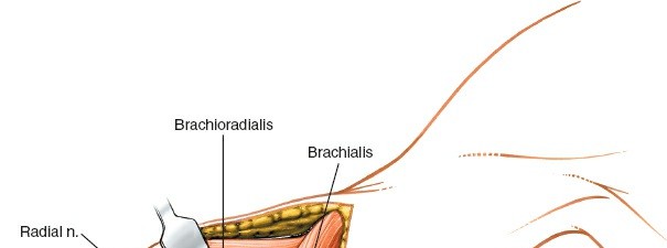 Illustration 65 for Mastering the Approach to the Distal Humerus: Safety & Skills