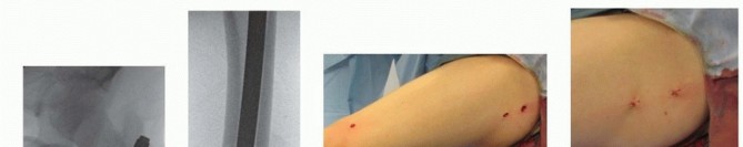 Illustration 25 for Pediatric Femoral Nailing: Targeting the Right aspect of the greater Trochanter