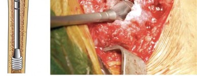 Illustration 18 for Mastering Cementing Technique Femur: A Step-by-Step Guide