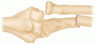 Mastering Proximal Ulna Fractures & Dislocation of the Radial