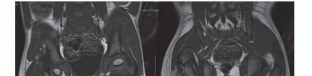 Illustration 8 for Treatment for Congenital Femoral Deficiency: What You Need to Know