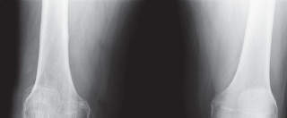 Cemented TKA Figure: Your Visual Guide to Surgical Success