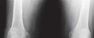 استبدال مفصل الركبة بالإسمنت: دليلك الشامل لعملية ناجحة مع الأستاذ الدكتور محمد هطيف