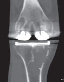 Illustration 7 for Porous Metal Cones: Biologic Fixation for Severe Bone Loss