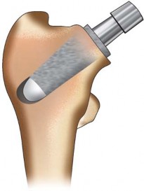 Illustration 65 for The Silent Hip: Achieving a Truly Silent, Pain-Free Joint
