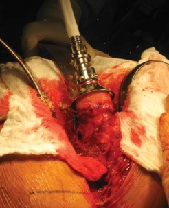 Illustration 61 for Metal on Metal Resurfacing: Enhanced Posterior Soft Tissue Repair