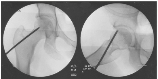 Illustration 3 for Head-Sparing for Osteonecrosis of the Femoral: Preserve Your Hip