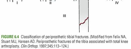 Illustration 9 for Periprosthetic Fractures: Causes, Risks, & Effective Treatment