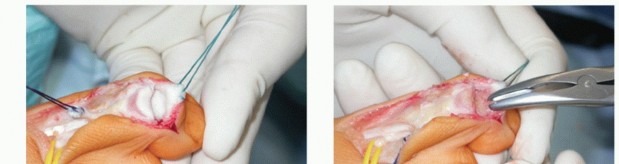 Illustration 26 for How Achilles Tendon Lengthening Fixes Equinocavovarus Foot