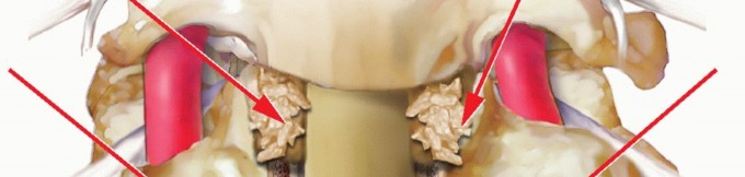 Illustration 17 for Stop Numbness & Instability: Corpectomy and Fusion Guide