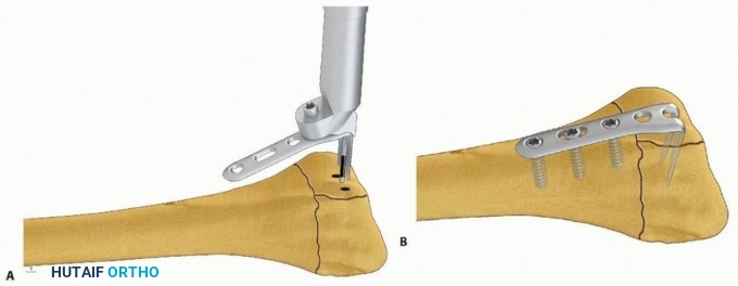 Illustration 42 for Fragment-Specific Fixation: Restore Carpal Facet Horizon