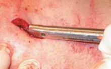 Illustration 20 for Pediatric Tibial Fractures: Avoid Mistakes, Ensure Optimal Healing