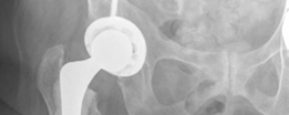 Illustration 7 for Analyzing a Hybrid Primary Hip Arthroplasty Patient Case