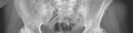 Advanced Bilateral Simultaneous THA: Uncemented Monobloc Case Title