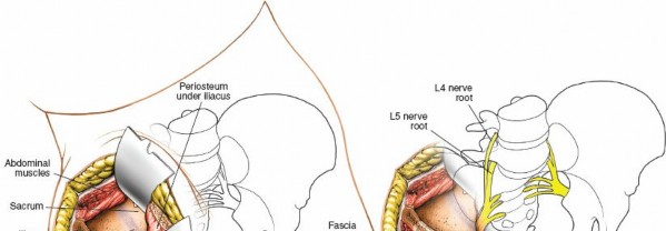 Illustration 22 for Mastering the Posterior Iliac Crest for Bone Graft Harvest