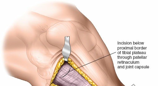 Illustration 11 for Surgical Access: Mastering the Tibia's Surface & Fibula Approaches